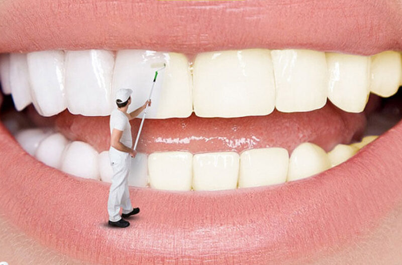 Tẩy trắng răng tại HELIA nhanh chóng - hiệu quả - lâu bền