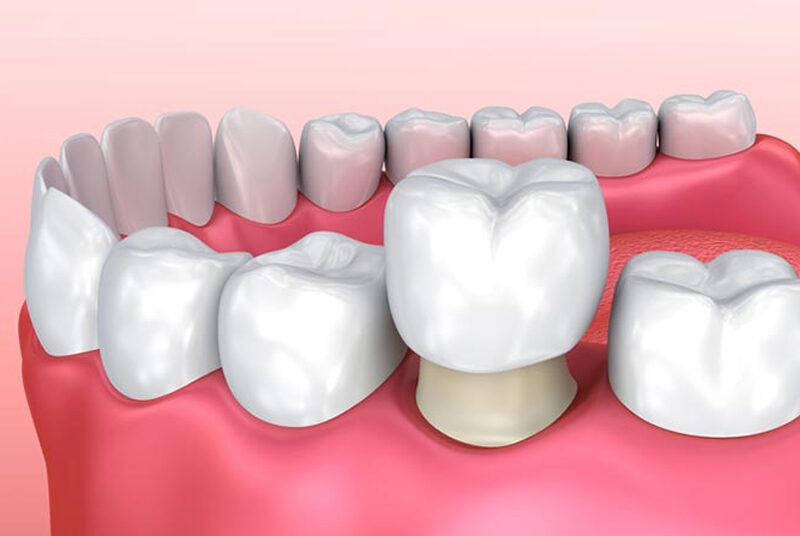 Bọc răng sứ - Bảo vệ răng bị chết tuỷ